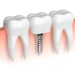 Choose the Right Way to Whiten and Brighten Your Smile!